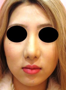 ①術後　1ヶ月　正面